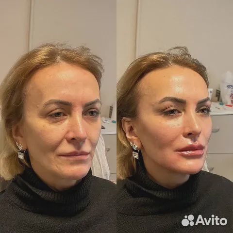 Минус 15 лет за 1 процедуру. СМАС лифтинг