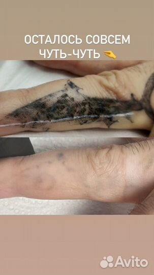 Лазерное удаление тату и татуажа. Ремувер