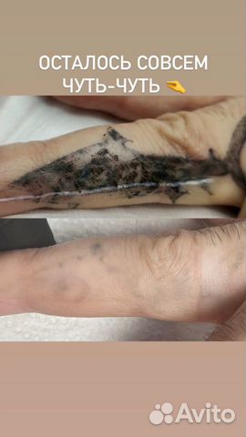 Лазерное удаление тату и татуажа. Ремувер