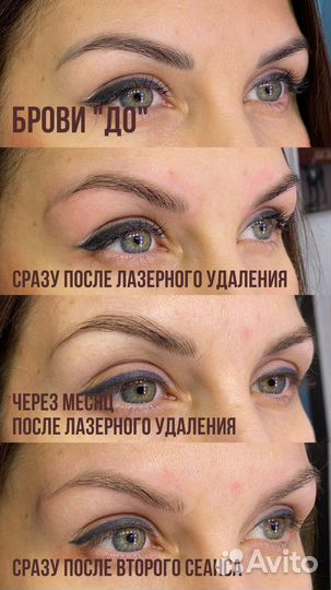 Удаление татуажа