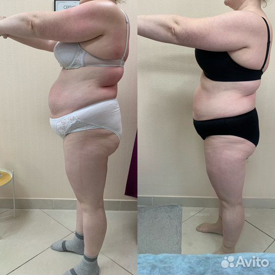 Массаж LPG лица и тела