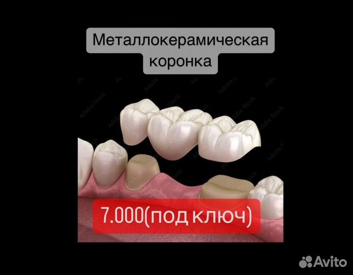 Коронка металлокерамика