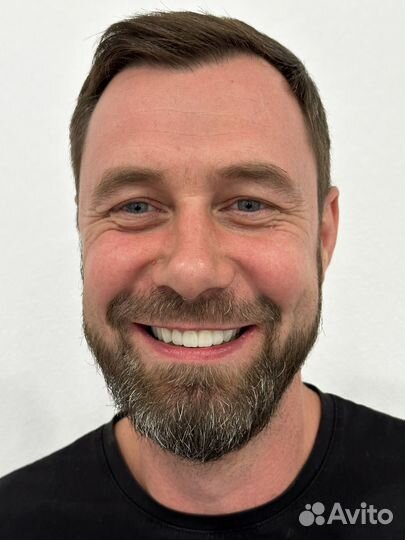 Протезирование зубов, керамические виниры