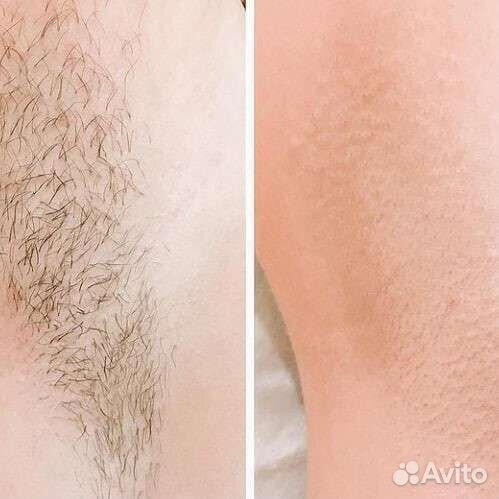 Шугаринг, Ваксинг