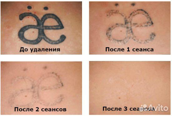 Удаление тату