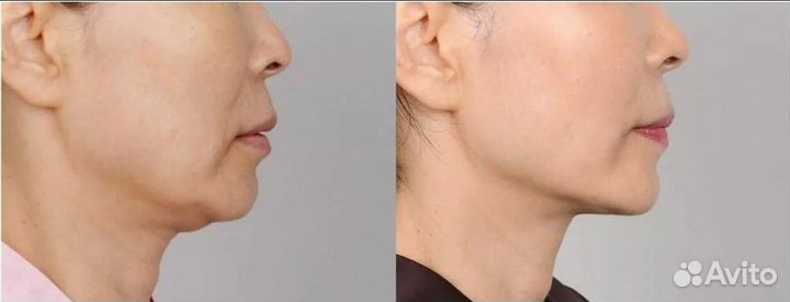 Модели на удаление второго подбородка (бесплатно)
