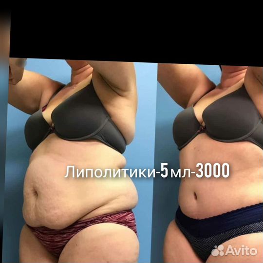 Модель на увеличение губ