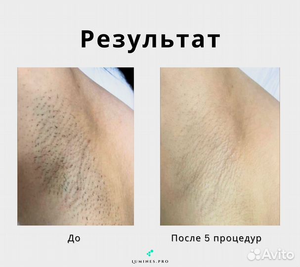 Аппарат для эпиляции Lumines Max’One 1200