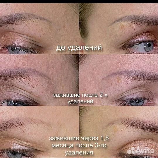 Удаление татуажа перманентного макияжа бровей губ