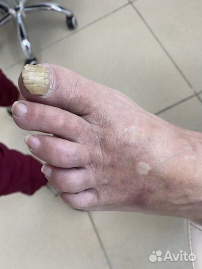 Парамедицинский педикюр