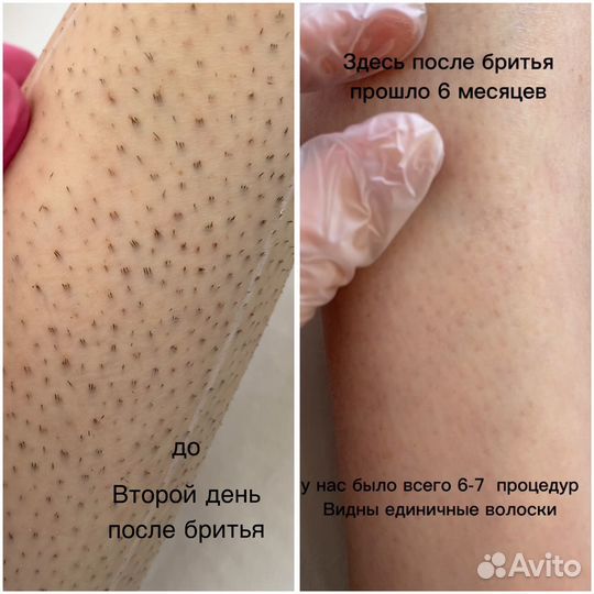 Лазерная эпиляция