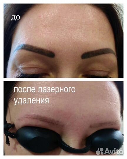 Удаление татуаж,тату и пигментных пятен