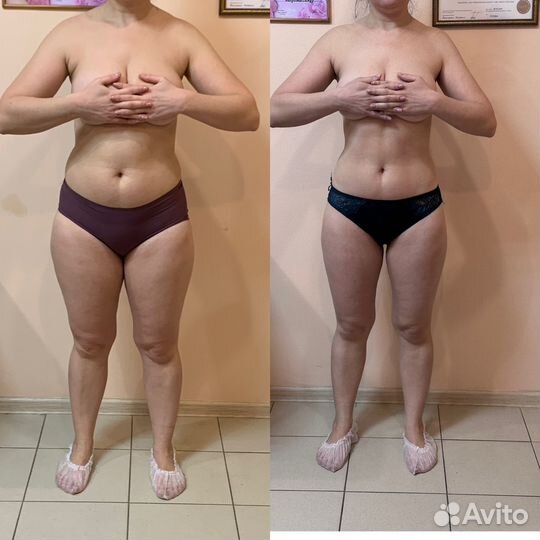 Эндо - Сфера, LPG массаж,вакуумный,корекция фигуры