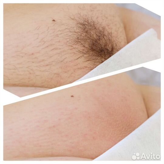 Шугаринг. Депиляция воском