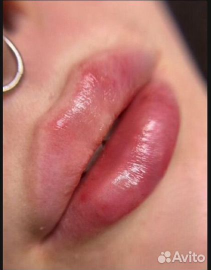 Увеличение губ