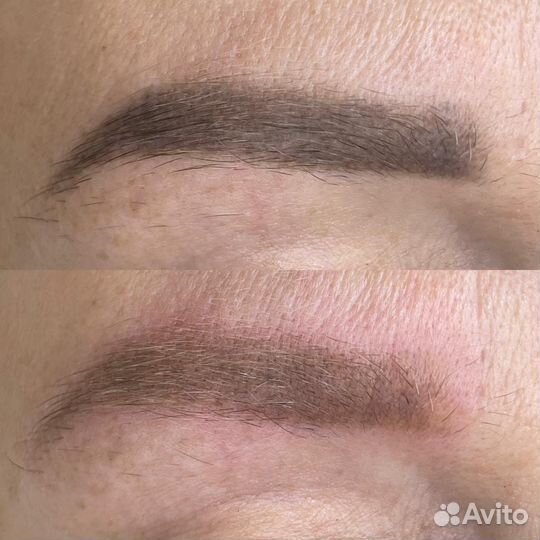 Обучение удаление татуажа лазером