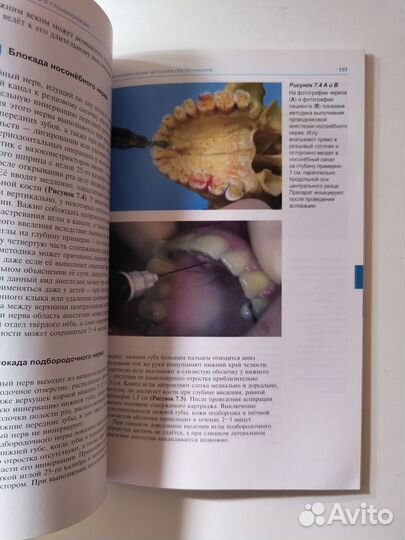 Местная анестезия в стоматологии. Баарт, Бранд